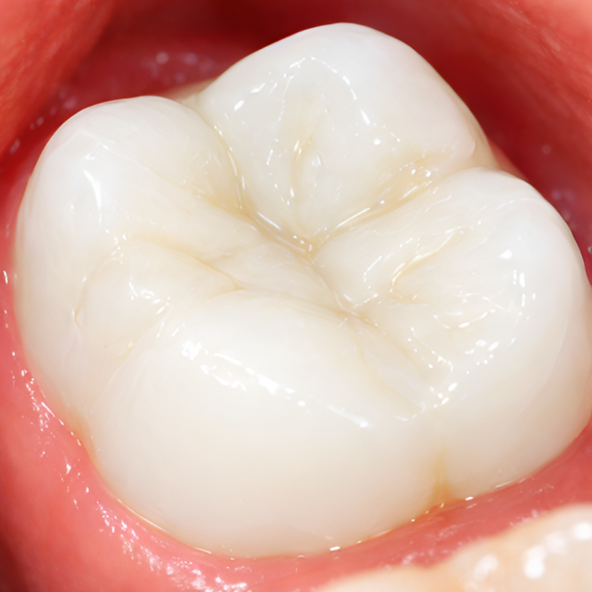 Dents après Novirna